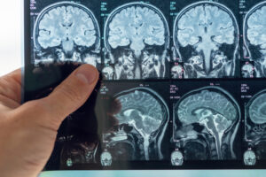 The doctor analyzes an MRI image of the brain.